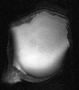 Figure 5 for case Large cyst above a degenerated acromioclavicular joint ( RID1895 )